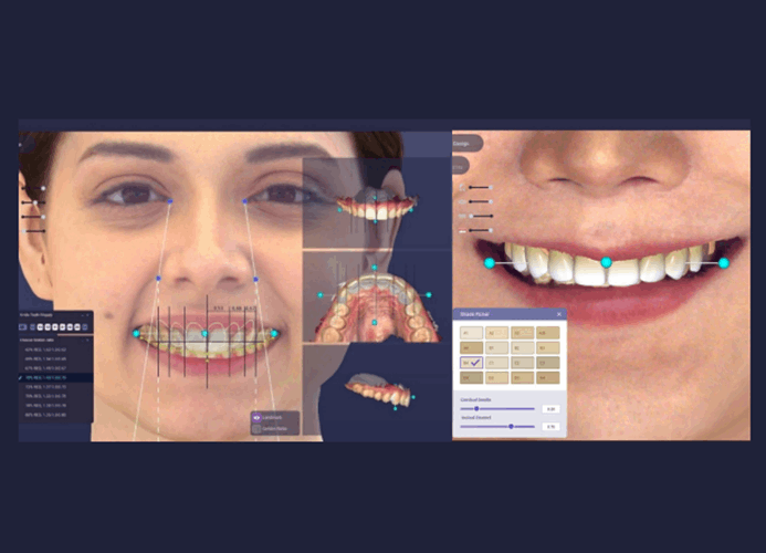 라미네이트 비니쉬