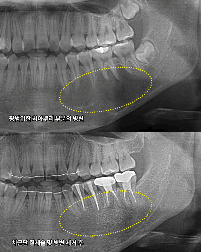 치근단절제가 필요한 경우