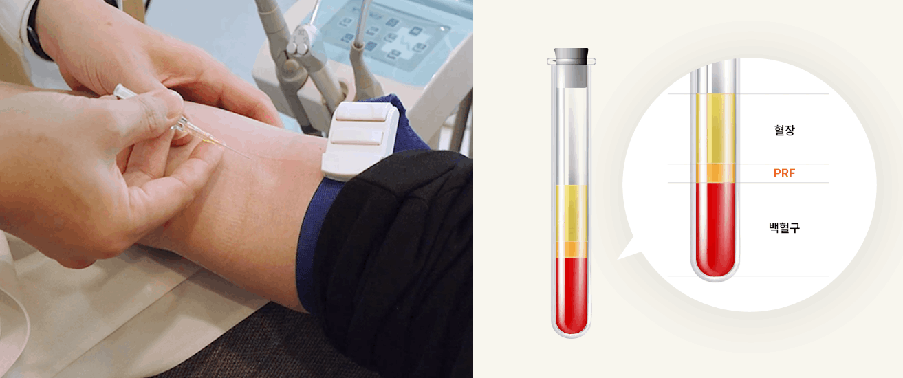 자가혈 PRF(성장인자) 임플란트