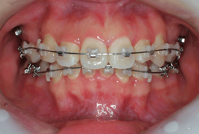 01. 세라믹 장치