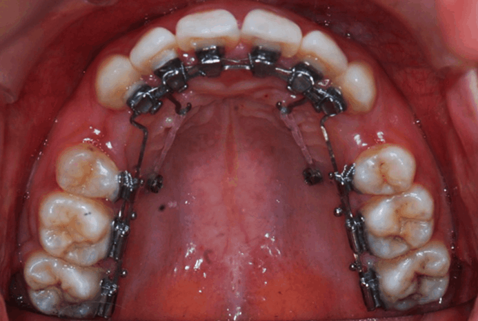 03. 설측교정장치/ 2D교정/ 인코그니토