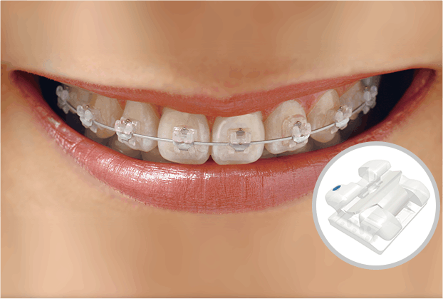 04.데이몬 / 클리피씨 교정장치