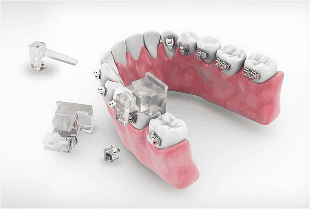 06.오라픽스 교정장치