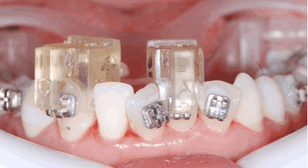 교정 장치 부착