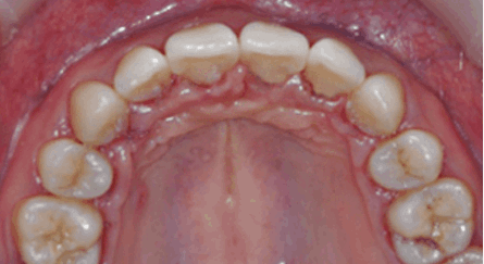 교정 장치 제거