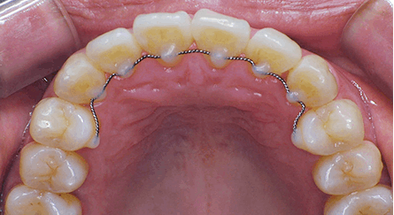 교정 후 유지장치