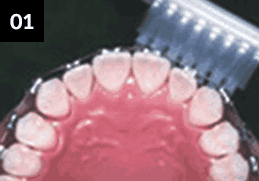 앞니를 닦는 방법