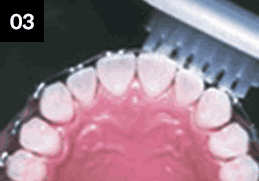 앞니를 닦는 방법