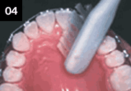 앞니를 닦는 방법