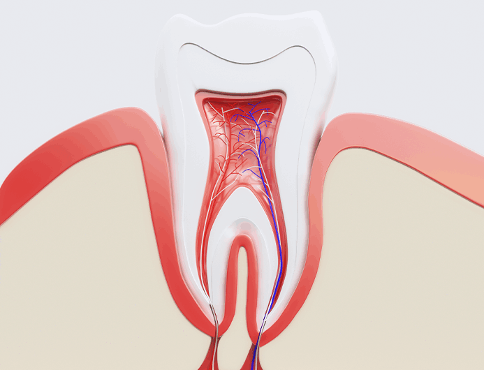 아프지 않은 신경치료