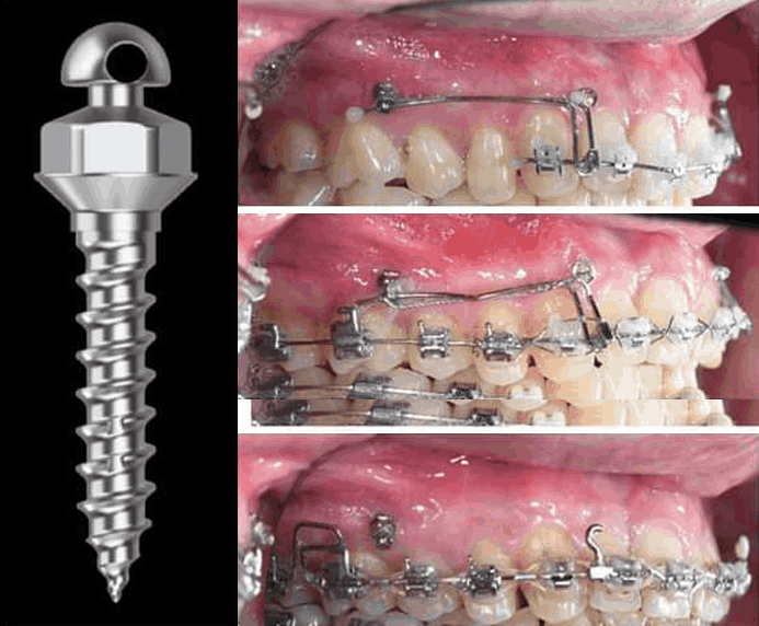 수면치아교정이란?