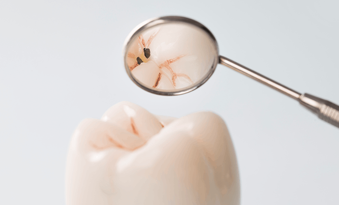 수면 충치 치료