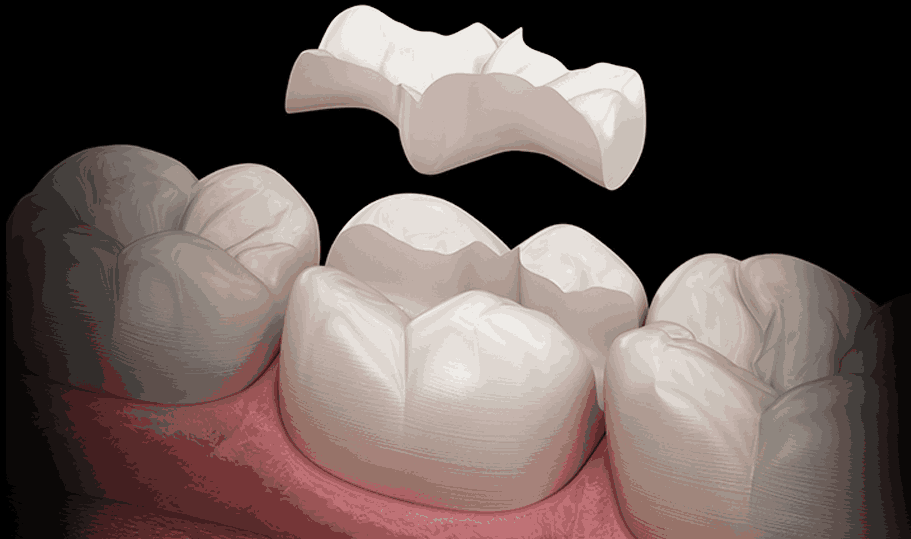 디지털 세라믹 인레이 충치치료