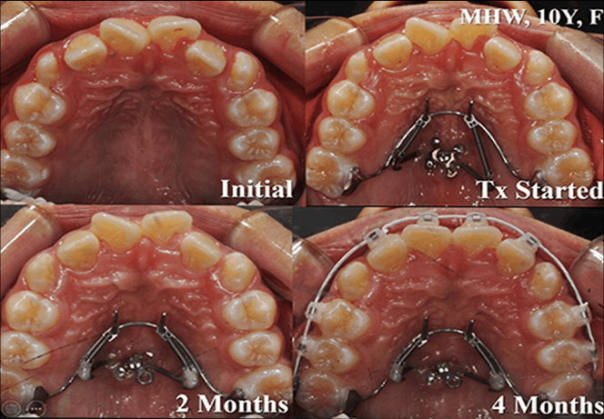 바이오 급속교정