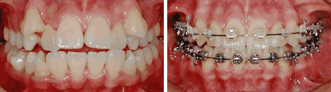 덧니 순측 오라픽스 교정
