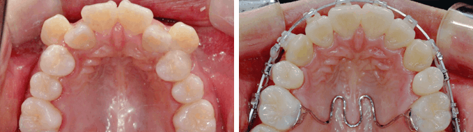 덧니 순측 오라픽스 교정