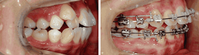 덧니 순측 오라픽스 교정