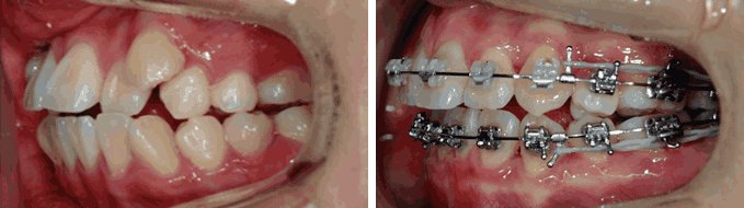 덧니 순측 오라픽스 교정