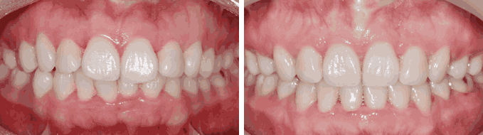 덧니 순측 오라픽스 교정