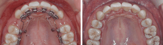 덧니 순측 오라픽스 교정