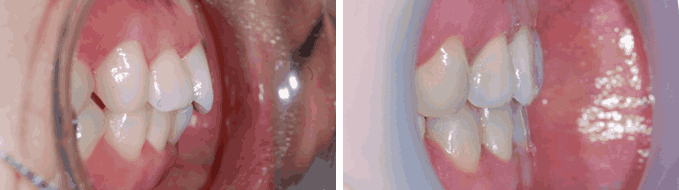 덧니 순측 오라픽스 교정