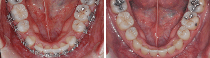 덧니 순측 오라픽스 교정