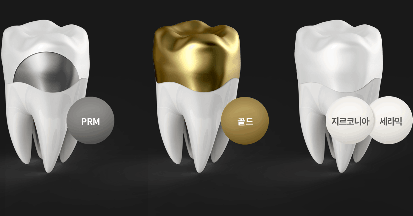 크라운 심미보철 종류