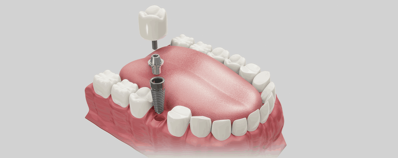 발치즉시 임플란트