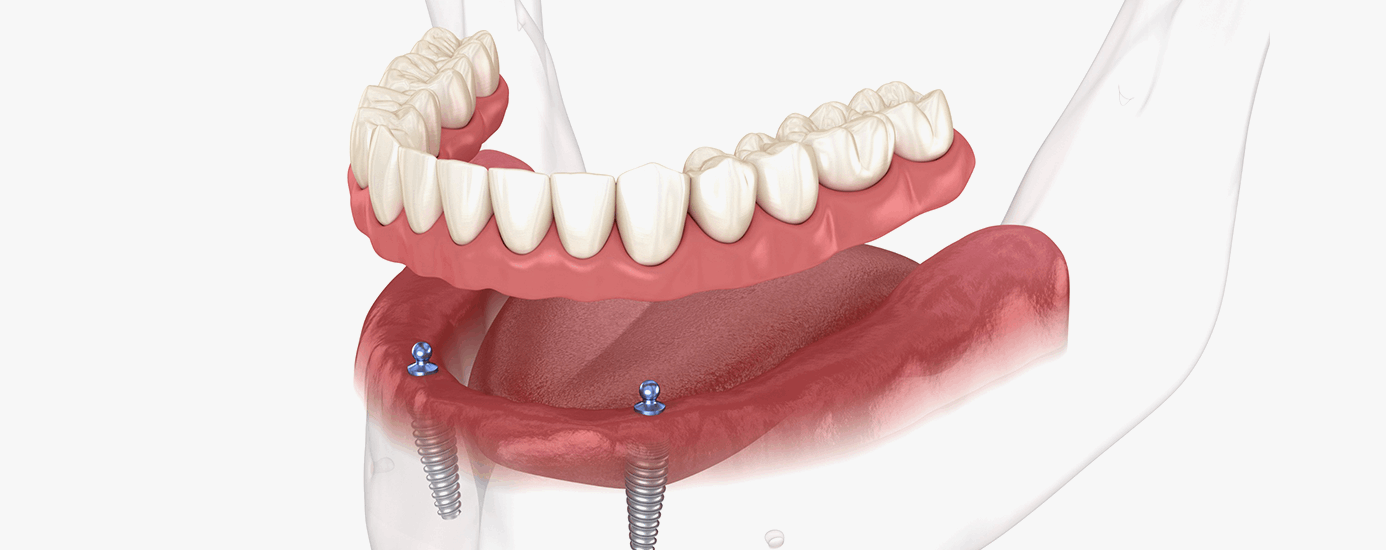 부담없이 불편함을 보완한 임플란트 틀니