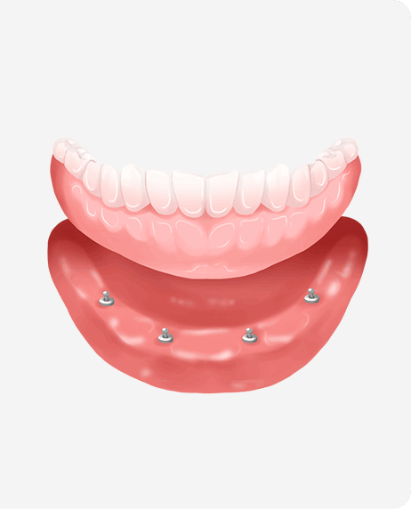 임플란트 틀니 시술과정