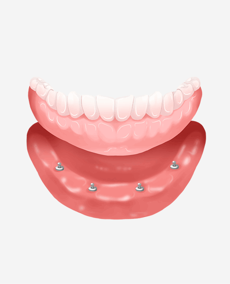 임플란트 틀니 시술과정