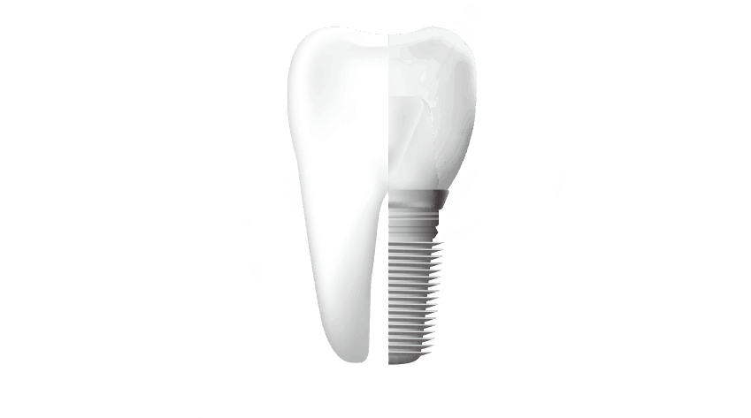 임플란트 이미지