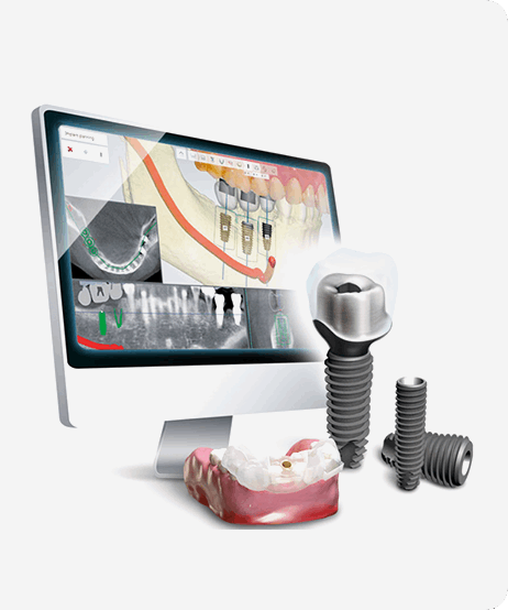 디지털 임플란트 장점