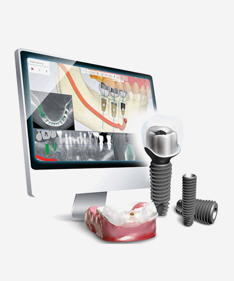 디지털 임플란트 장점