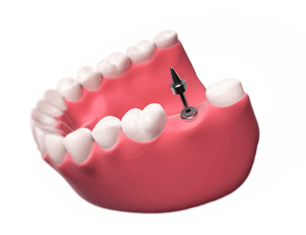 적은통증, 빠른 회복