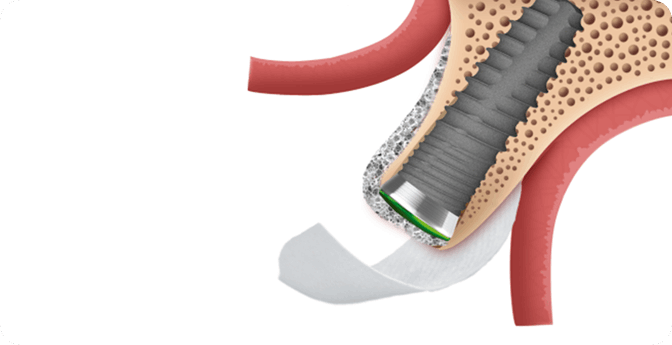 GBR 골유도 재생술