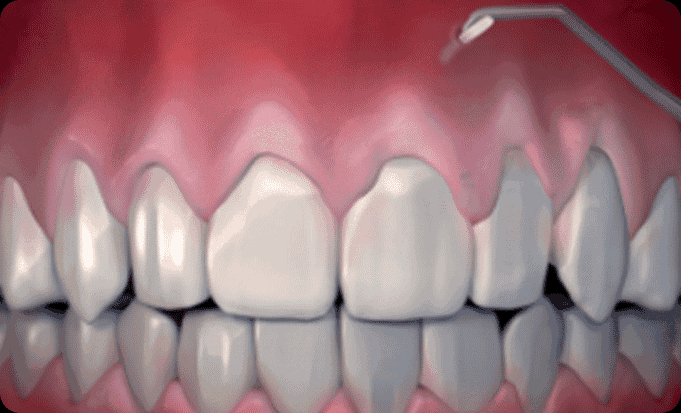 잇몸재생술/핀홀수술