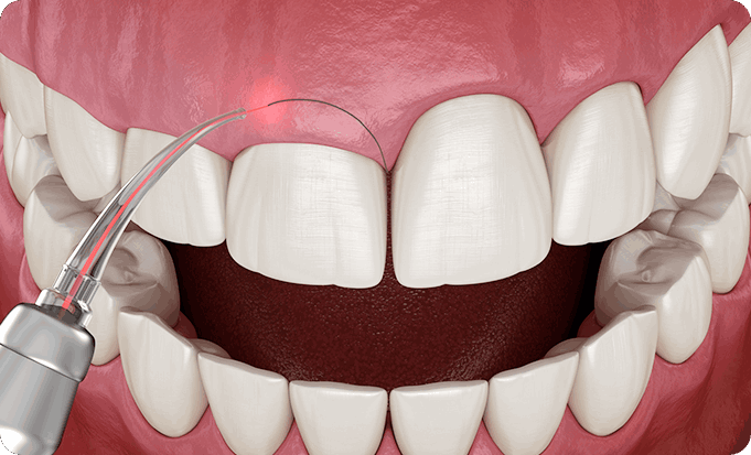 잇몸재생술/핀홀수술