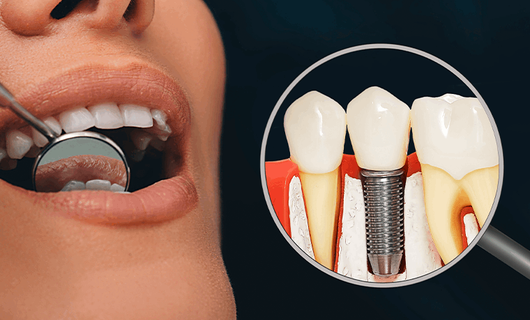 임플란트의 흔들림