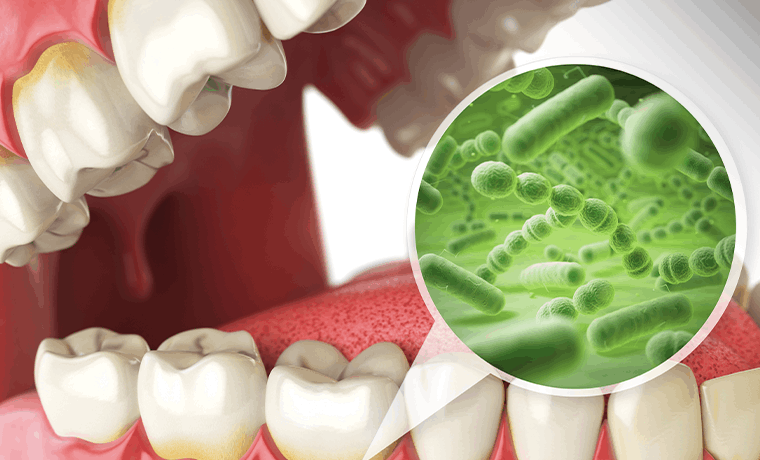 임플란트 주위염