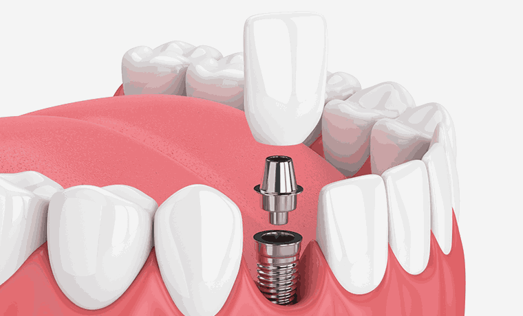 임플란트의 보철물