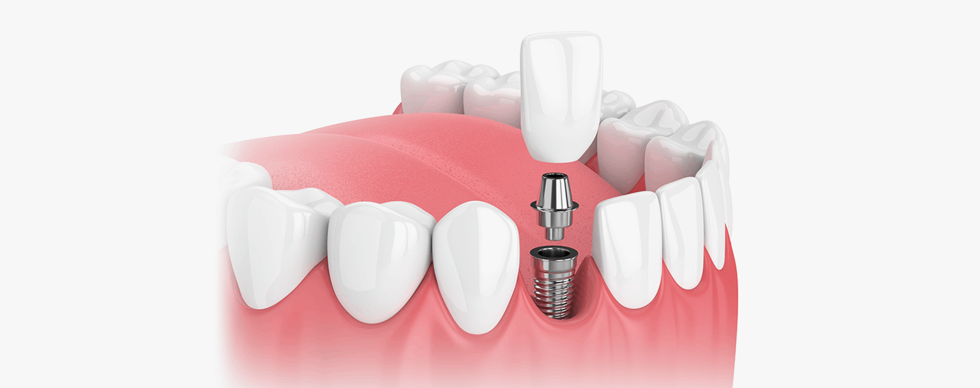 뼈 이식 임플란트