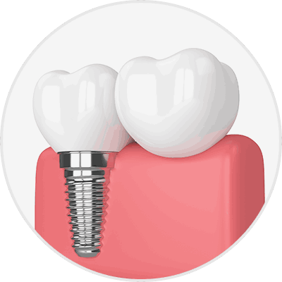 임플란트 VS 브릿지