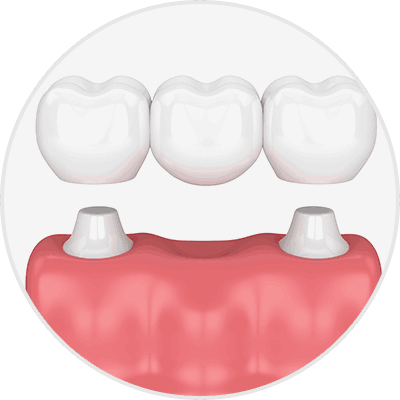임플란트 VS 브릿지