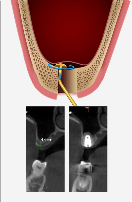 상악동 뼈이식 장점