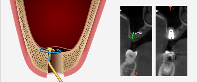 상악동 뼈이식 장점