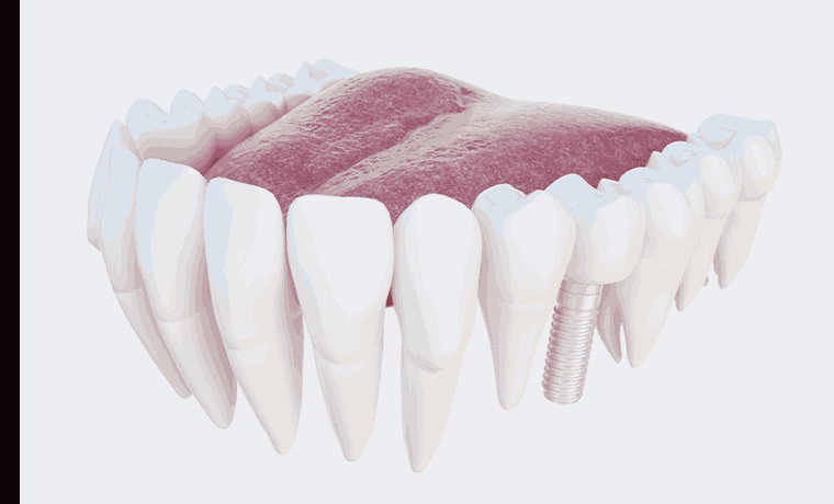 뼈중심 임플란트 식립