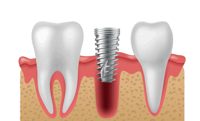 발치 즉시식립 뼈이식 임플란트