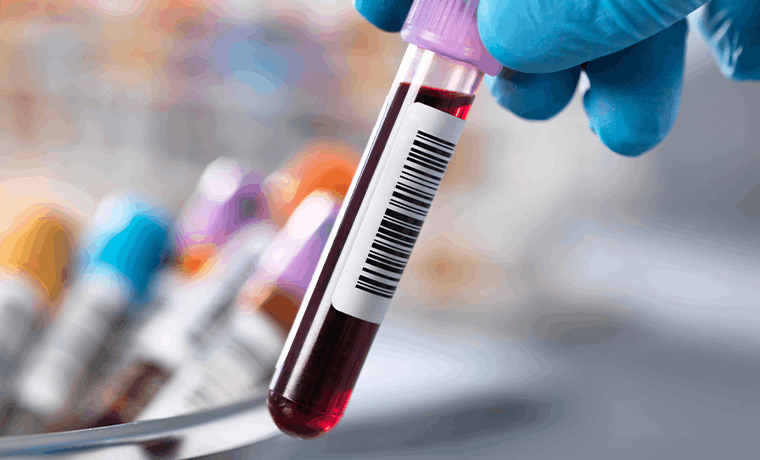 자가혈 PRF 임플란트