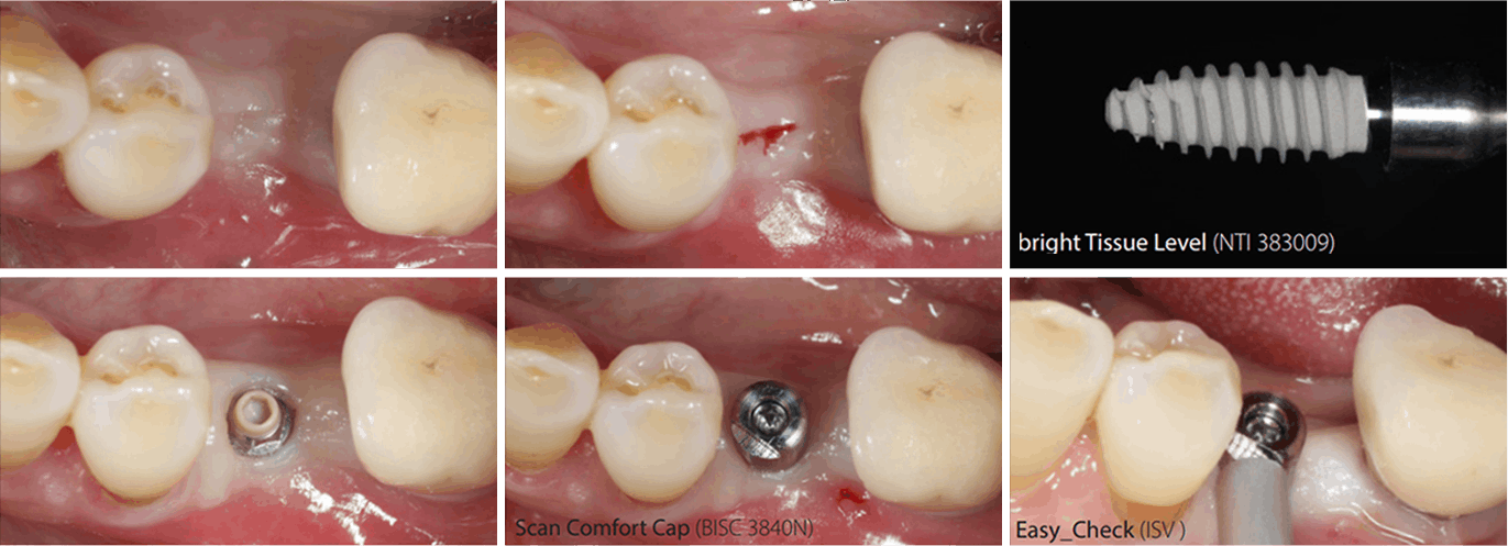 최소침습 임플란트란?